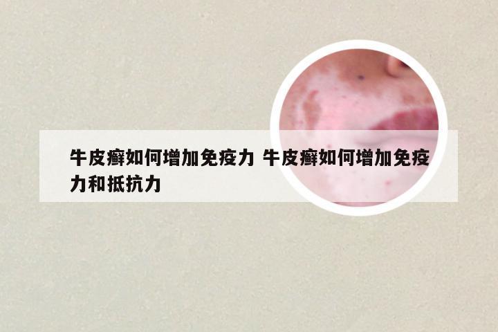 牛皮癣如何增加免疫力 牛皮癣如何增加免疫力和抵抗力