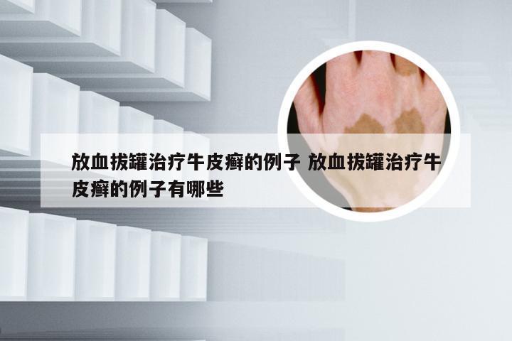 放血拔罐治疗牛皮癣的例子 放血拔罐治疗牛皮癣的例子有哪些