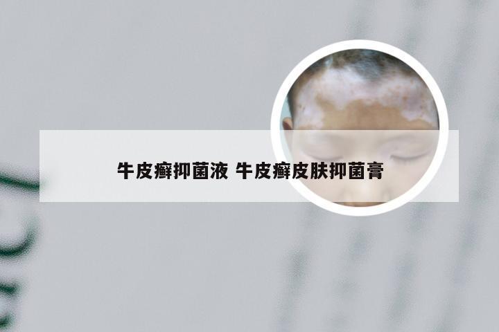 牛皮癣抑菌液 牛皮癣皮肤抑菌膏