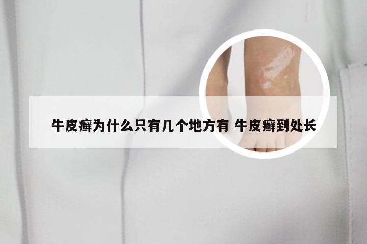 牛皮癣为什么只有几个地方有 牛皮癣到处长