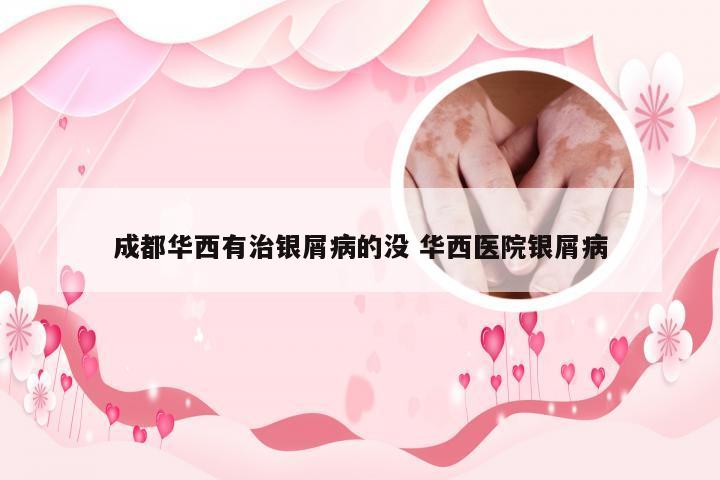 成都华西有治银屑病的没 华西医院银屑病