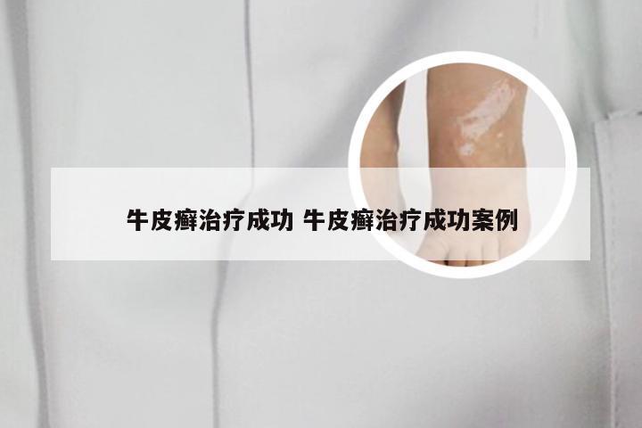 牛皮癣治疗成功 牛皮癣治疗成功案例