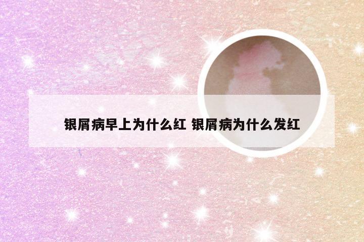 银屑病早上为什么红 银屑病为什么发红
