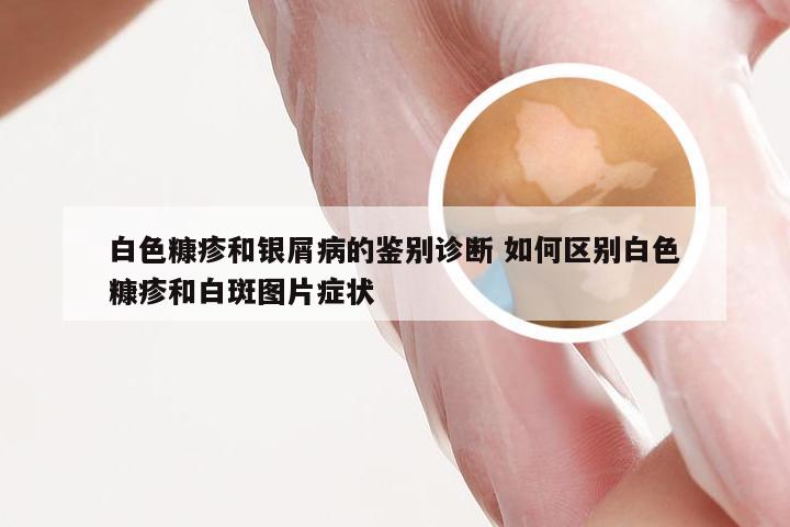 白色糠疹和银屑病的鉴别诊断 如何区别白色糠疹和白斑图片症状