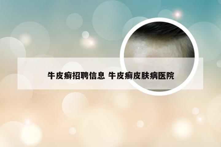 牛皮癣招聘信息 牛皮癣皮肤病医院