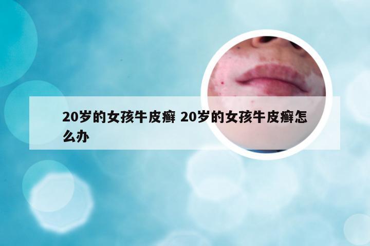 20岁的女孩牛皮癣 20岁的女孩牛皮癣怎么办
