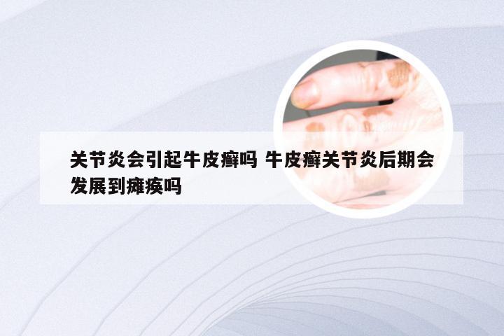 关节炎会引起牛皮癣吗 牛皮癣关节炎后期会发展到瘫痪吗
