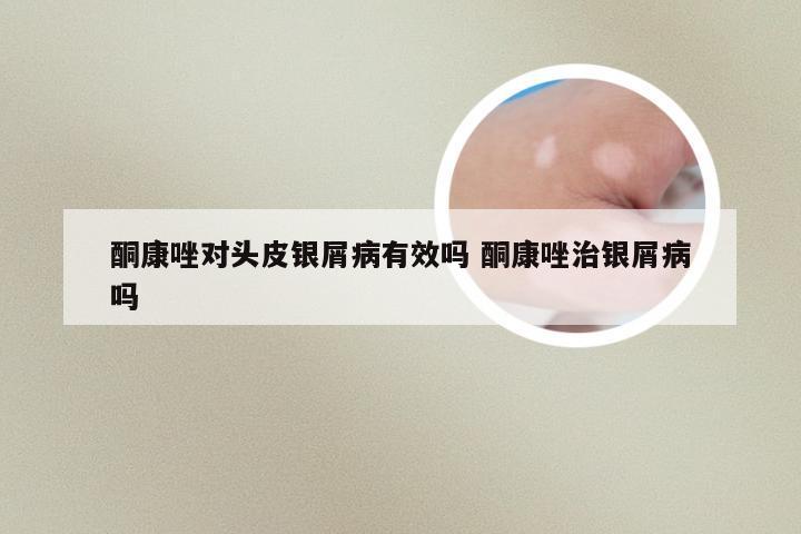 酮康唑对头皮银屑病有效吗 酮康唑治银屑病吗