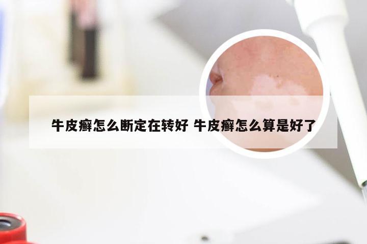 牛皮癣怎么断定在转好 牛皮癣怎么算是好了