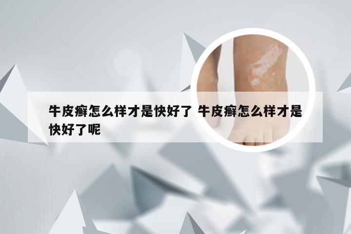 牛皮癣怎么样才是快好了 牛皮癣怎么样才是快好了呢