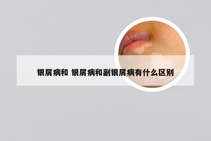 银屑病和 银屑病和副银屑病有什么区别