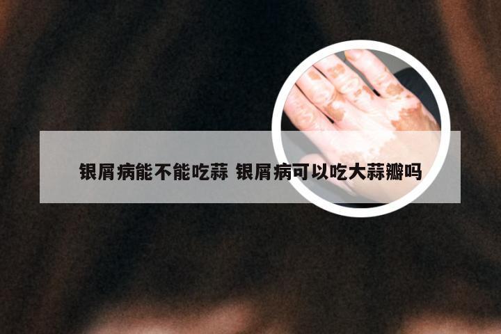 银屑病能不能吃蒜 银屑病可以吃大蒜瓣吗