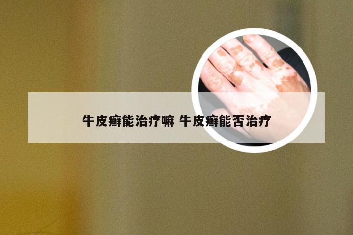 牛皮癣能治疗嘛 牛皮癣能否治疗
