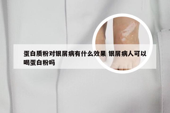 蛋白质粉对银屑病有什么效果 银屑病人可以喝蛋白粉吗