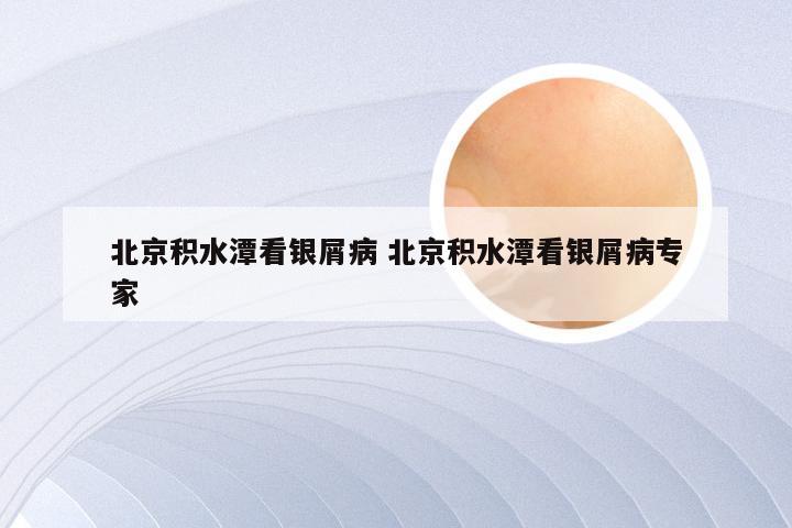北京积水潭看银屑病 北京积水潭看银屑病专家