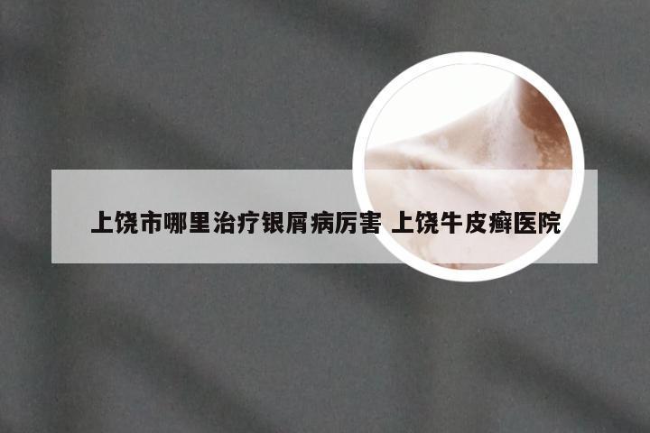 上饶市哪里治疗银屑病厉害 上饶牛皮癣医院