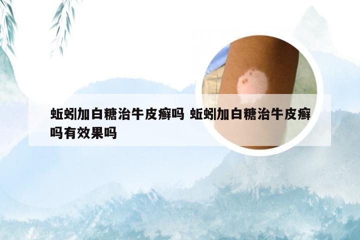 蚯蚓加白糖治牛皮癣吗 蚯蚓加白糖治牛皮癣吗有效果吗