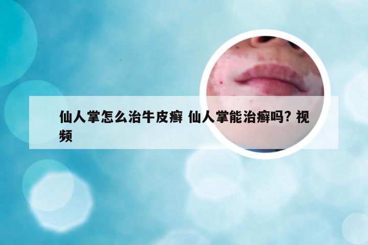 仙人掌怎么治牛皮癣 仙人掌能治癣吗? 视频