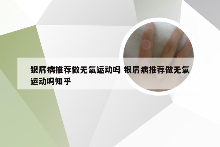 银屑病推荐做无氧运动吗 银屑病推荐做无氧运动吗知乎