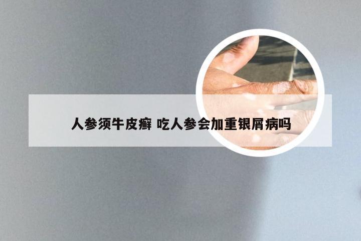 人参须牛皮癣 吃人参会加重银屑病吗