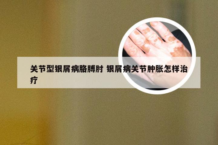 关节型银屑病胳膊肘 银屑病关节肿胀怎样治疗