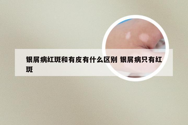 银屑病红斑和有皮有什么区别 银屑病只有红斑