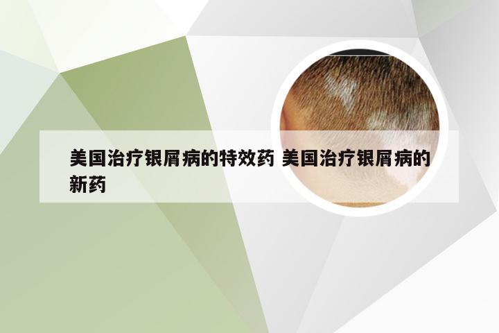 美国治疗银屑病的特效药 美国治疗银屑病的新药