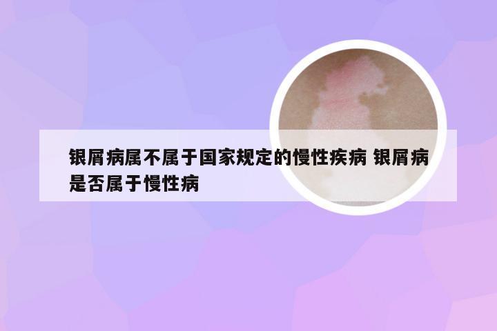 银屑病属不属于国家规定的慢性疾病 银屑病是否属于慢性病