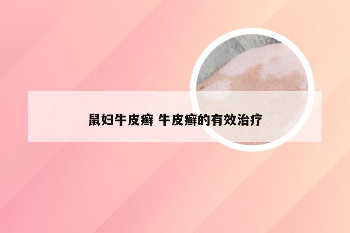 鼠妇牛皮癣 牛皮癣的有效治疗