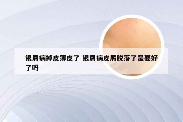 银屑病掉皮薄皮了 银屑病皮屑脱落了是要好了吗