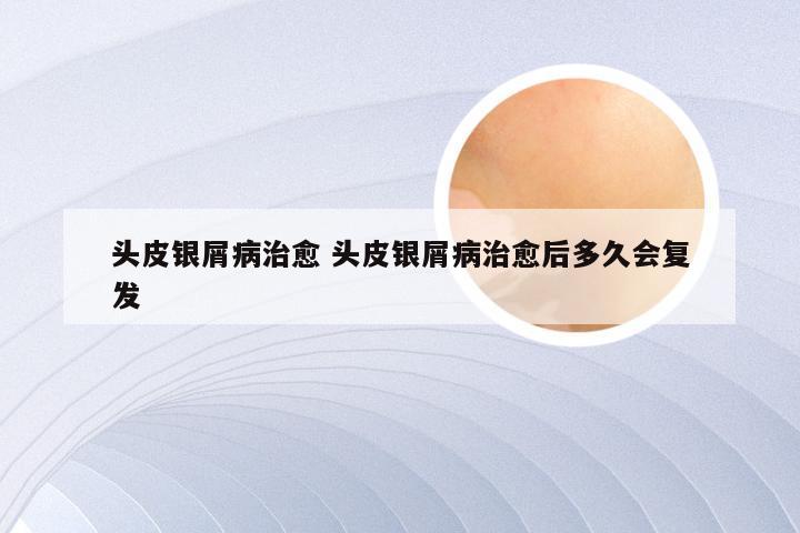 头皮银屑病治愈 头皮银屑病治愈后多久会复发
