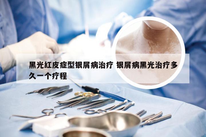 黑光红皮症型银屑病治疗 银屑病黑光治疗多久一个疗程