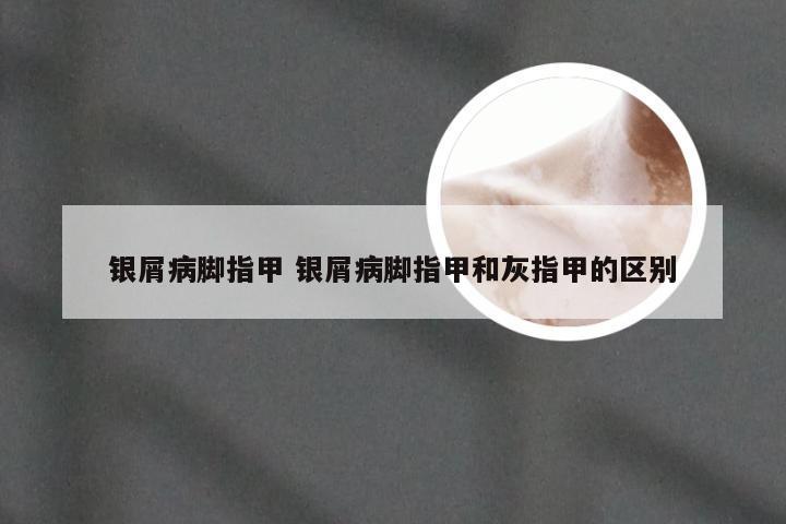 银屑病脚指甲 银屑病脚指甲和灰指甲的区别