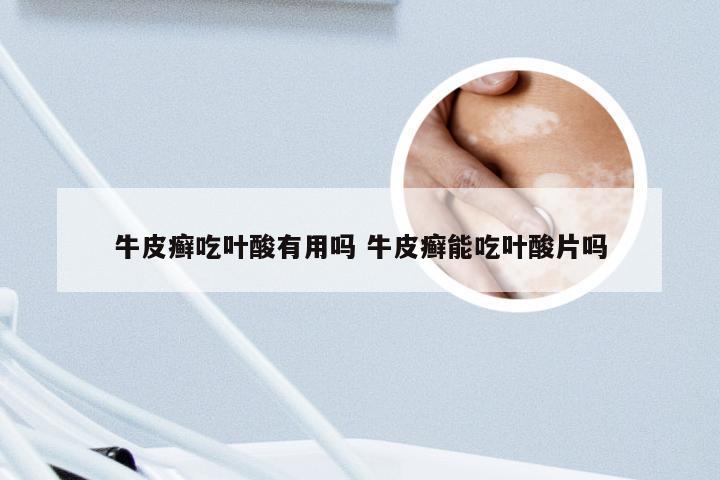 牛皮癣吃叶酸有用吗 牛皮癣能吃叶酸片吗