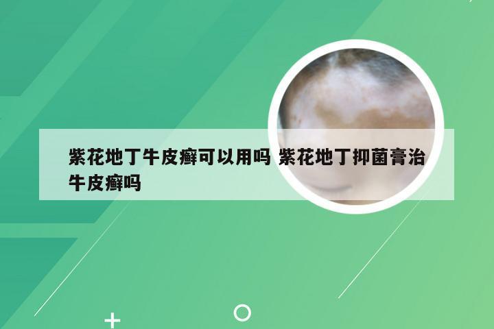 紫花地丁牛皮癣可以用吗 紫花地丁抑菌膏治牛皮癣吗