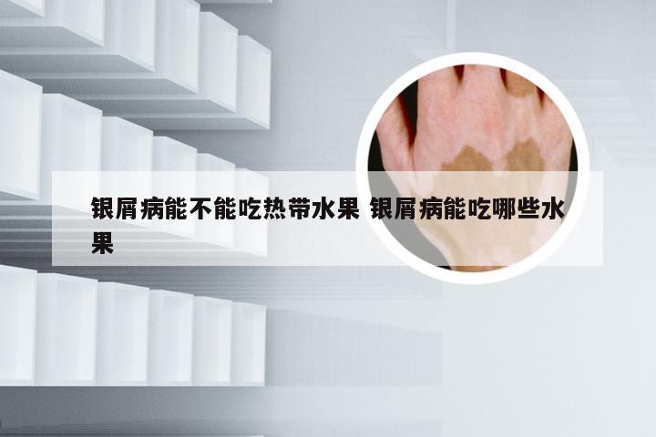 银屑病能不能吃热带水果 银屑病能吃哪些水果