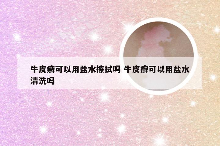 牛皮癣可以用盐水擦拭吗 牛皮癣可以用盐水清洗吗