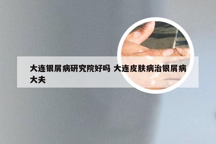 大连银屑病研究院好吗 大连皮肤病治银屑病大夫