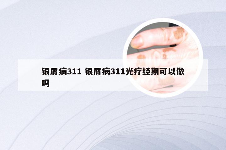 银屑病311 银屑病311光疗经期可以做吗