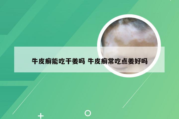 牛皮癣能吃干姜吗 牛皮癣常吃点姜好吗