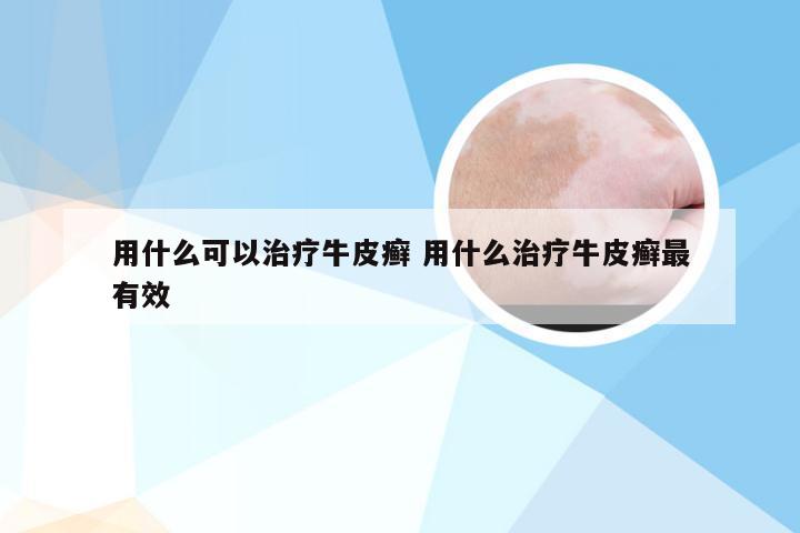 用什么可以治疗牛皮癣 用什么治疗牛皮癣最有效
