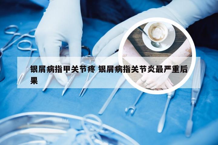 银屑病指甲关节疼 银屑病指关节炎最严重后果