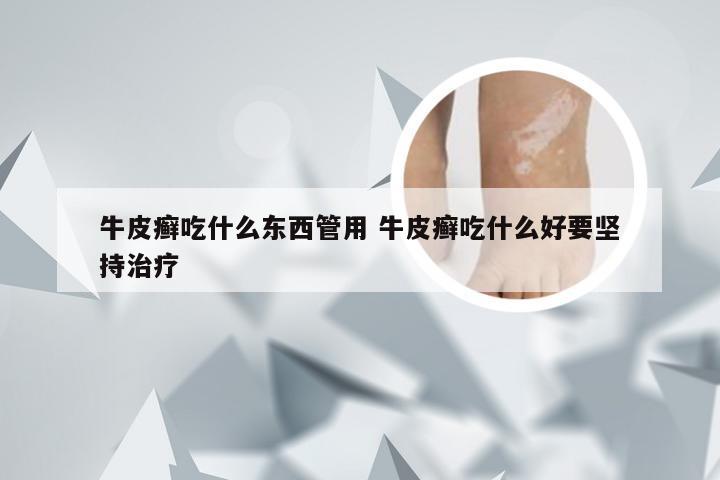 牛皮癣吃什么东西管用 牛皮癣吃什么好要坚持治疗