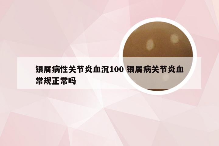 银屑病性关节炎血沉100 银屑病关节炎血常规正常吗