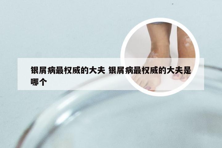银屑病最权威的大夫 银屑病最权威的大夫是哪个