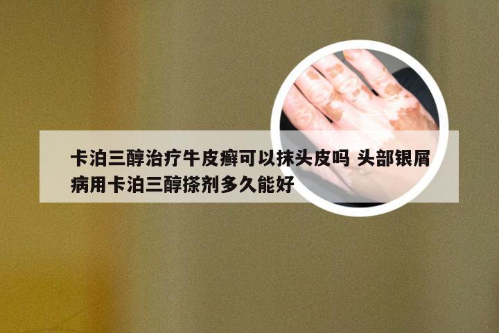 卡泊三醇治疗牛皮癣可以抹头皮吗 头部银屑病用卡泊三醇搽剂多久能好