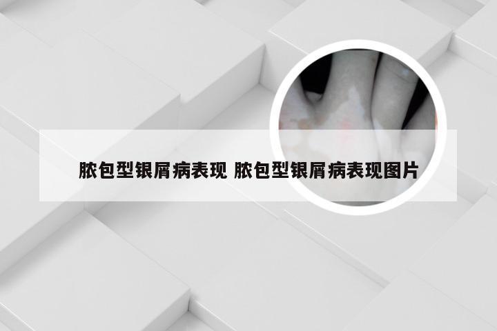 脓包型银屑病表现 脓包型银屑病表现图片