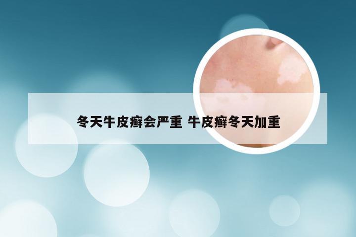 冬天牛皮癣会严重 牛皮癣冬天加重