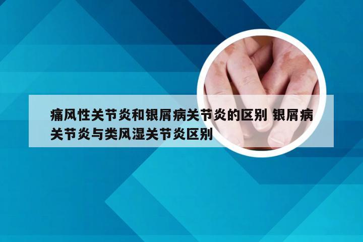 痛风性关节炎和银屑病关节炎的区别 银屑病关节炎与类风湿关节炎区别