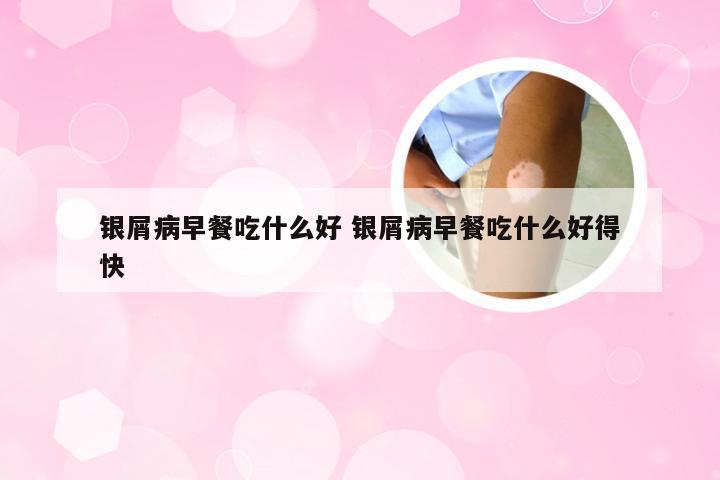 银屑病早餐吃什么好 银屑病早餐吃什么好得快